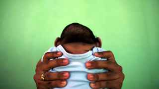 Un bebé con microcefalia.